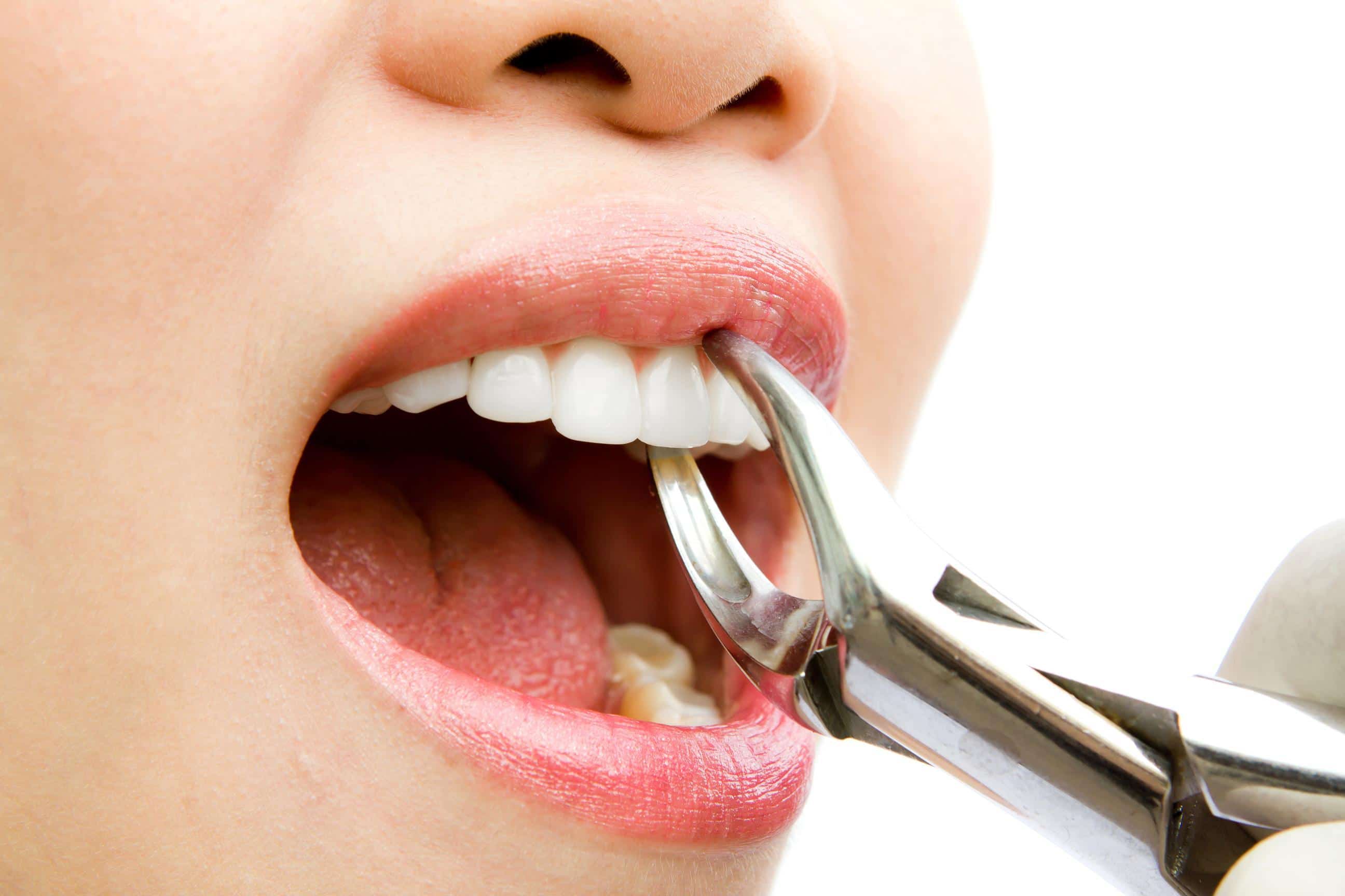 Alternative la extractia dentara