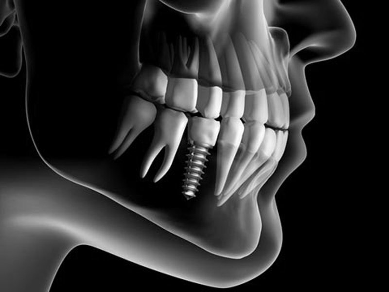Implant dentar MG Dental